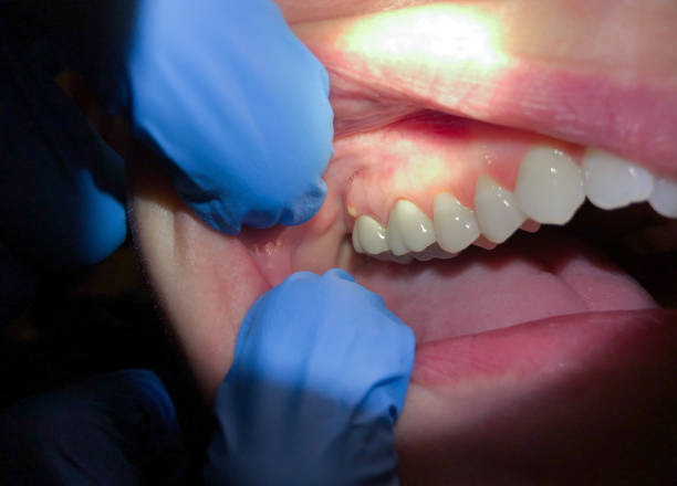 Best Emergency Gum Treatment in Cashmere, WA