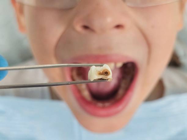 Best Emergency Wisdom Teeth Removal in Cashmere, WA